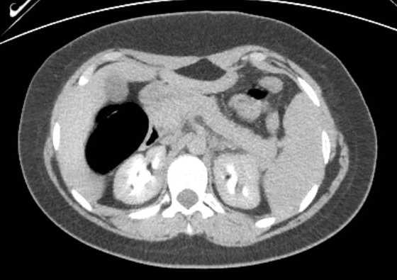 Acute unilateral nonhemorrhagic adrenal infarction (Radiopaedia 67560-76957 Axial renal excretory phase 42).jpg