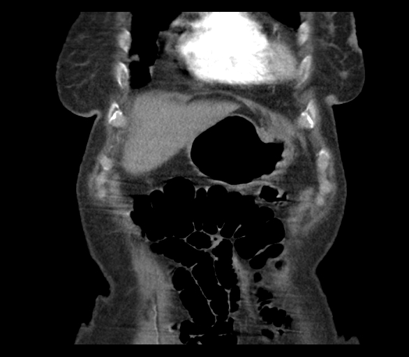 Adenocarcinoma of cecum (Radiopaedia 59222-66549 Coronal C+ arterial phase 10).jpg