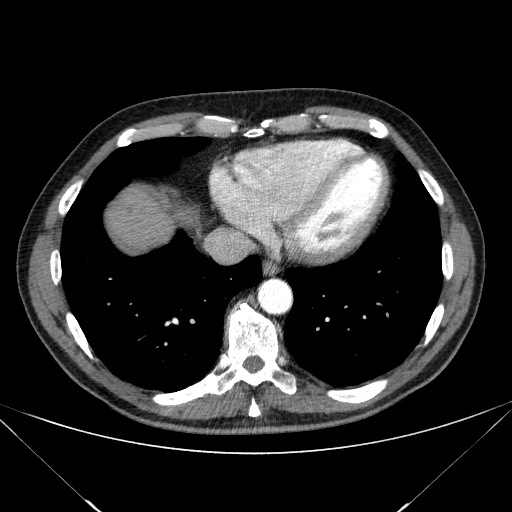 Adenocarcinoma of the lung (Radiopaedia 59871-67325 Axial C+ arterial phase 71).jpg