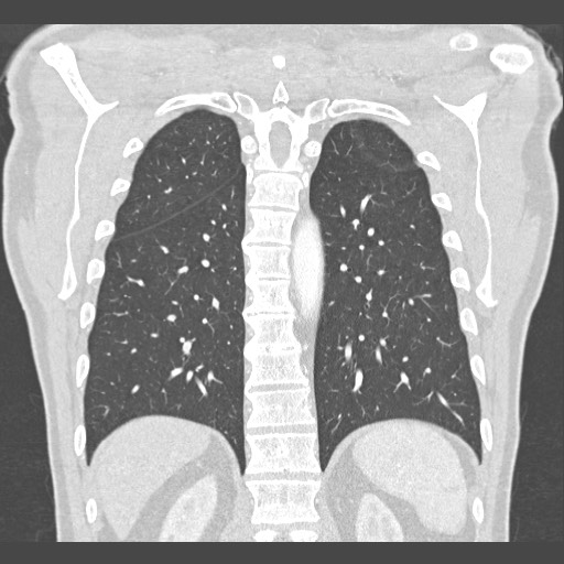 Adenocarcinoma of the lung (Radiopaedia 59871-67325 Coronal lung window 48).jpg