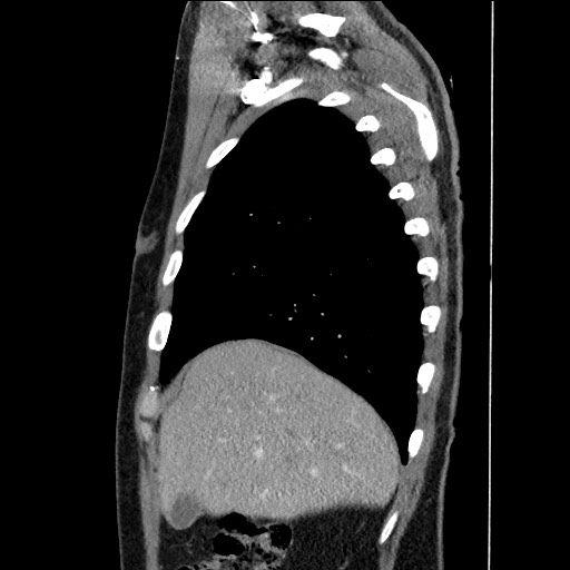 Adenocarcinoma of the lung (Radiopaedia 59871-67325 Sagittal C+ arterial phase 17).jpg