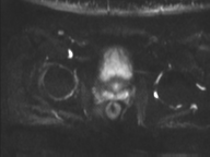 Adenocarcioma of rectum- T1 lesion (Radiopaedia 36921-38546 Axial DWI 11).png