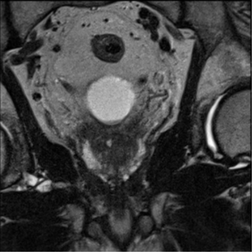 File:Adenocarcioma of rectum- T1 lesion (Radiopaedia 36921-38546 Coronal T2 17).png