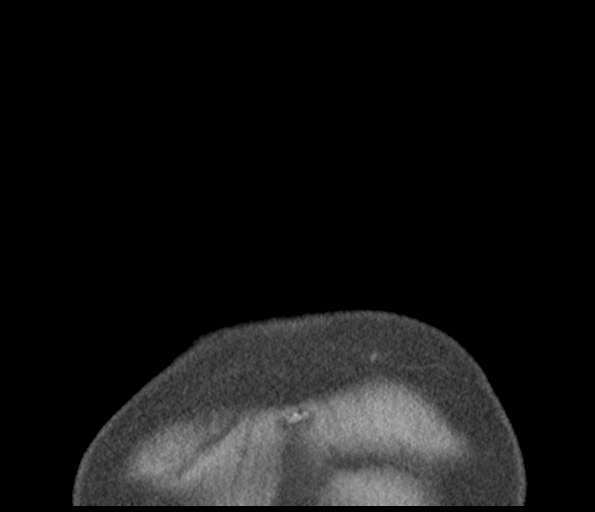 Adenocarcioma of rectum- T1 lesion (Radiopaedia 36921-38547 Coronal C+ arterial phase 3).png
