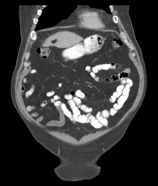 Adenocarcioma of rectum- T1 lesion (Radiopaedia 36921-38547 Coronal C+ portal venous phase 16).png