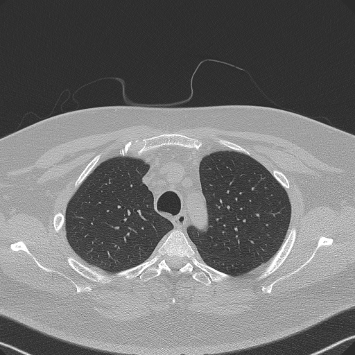 File:Adenoid cystic carcinoma of the trachea (Radiopaedia 49042-54137 Axial lung window 81).jpg