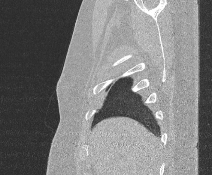 Adenoid cystic carcinoma of the trachea (Radiopaedia 49042-54137 Sagittal lung window 51).jpg