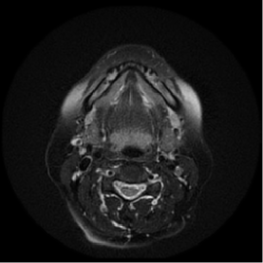 File:Adenoid cystic tumor of palate (Radiopaedia 46980-51519 Axial T2 12).png