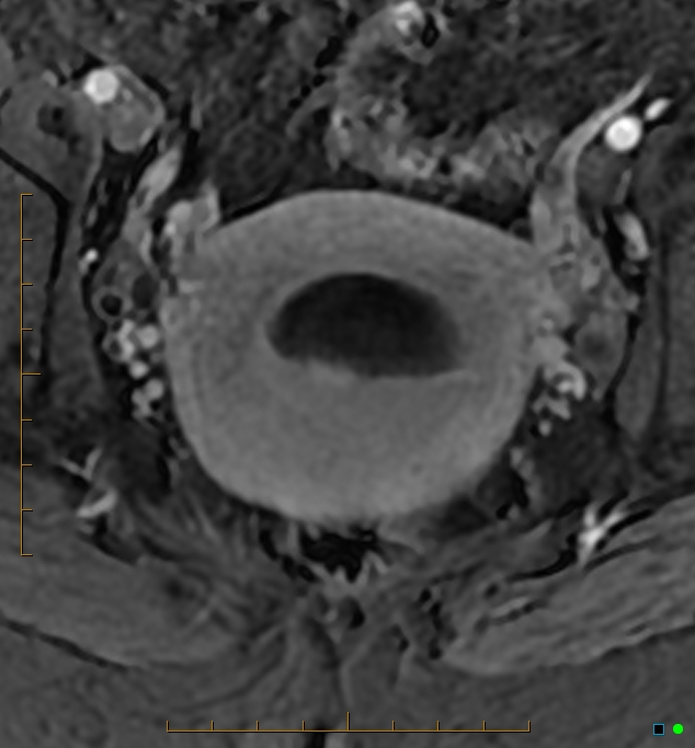 Adenomyosis uterus with hematometra (Radiopaedia 45779-50011 Axial T1 C+ fat sat 37).jpg