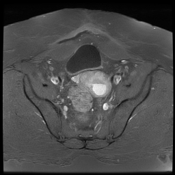 File:Adenomyosis within a didelphys uterus (Radiopaedia 70175-80215 Axial T1 C+ fat sat 24).jpg