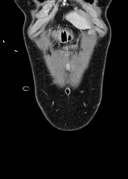 Adhesional small bowel obstruction (Radiopaedia 48397-53305 Coronal C+ portal venous phase 36).jpg