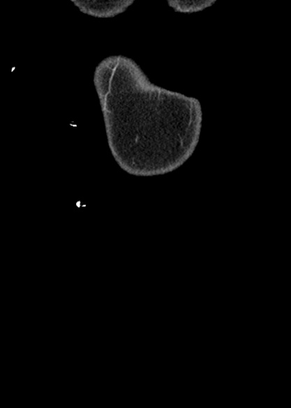 Adhesional small bowel obstruction (Radiopaedia 48397-53305 Coronal C+ portal venous phase 6).jpg