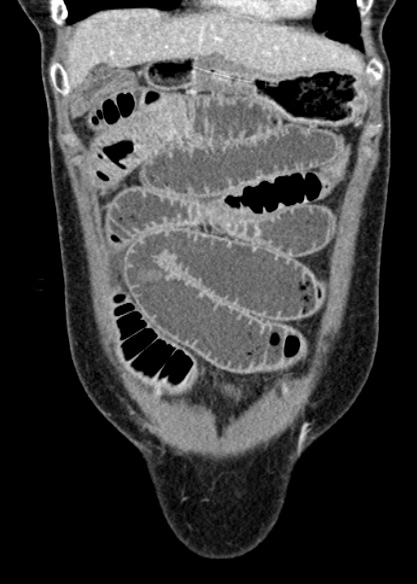 Adhesional small bowel obstruction (Radiopaedia 48397-53305 Coronal C+ portal venous phase 76).jpg