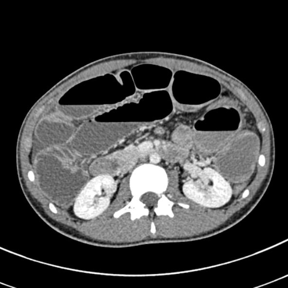 Adhesional small bowel obstruction (Radiopaedia 52107-57980 Axial C+ portal venous phase 47).jpg