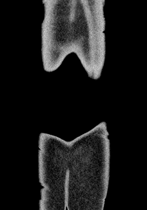Adhesional small bowel obstruction (Radiopaedia 58900-66131 Coronal C+ portal venous phase 239).jpg