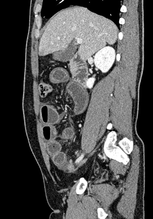 Adhesional small bowel obstruction (Radiopaedia 58900-66131 Sagittal C+ portal venous phase 90).jpg