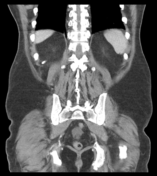 Adhesions within abdominal wall hernia (Radiopaedia 58283-65394 Coronal C+ portal venous phase 55).png