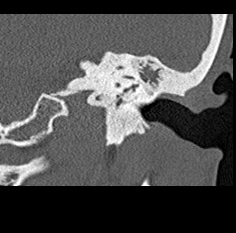 File:Adhesive chronic otitis media (Radiopaedia 14270-14148 Coronal bone window - left 18).jpg