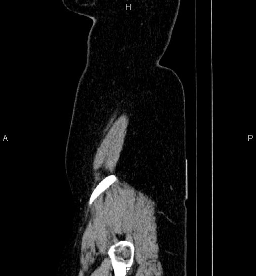 Adrenal cortical carcinoma (Radiopaedia 84882-100379 Sagittal C+ portal venous phase 1).jpg
