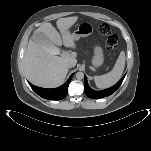 File:Adrenal cyst (Radiopaedia 45625-49778 Axial non-contrast 22).png