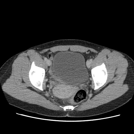 Adrenal cyst (Radiopaedia 64869-73813 Axial C+ portal venous phase 72).jpg