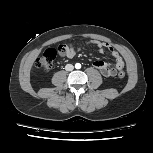 File:Adrenal gland trauma (Radiopaedia 81351-95078 Axial Dual bolus trauma C+ 85).jpg