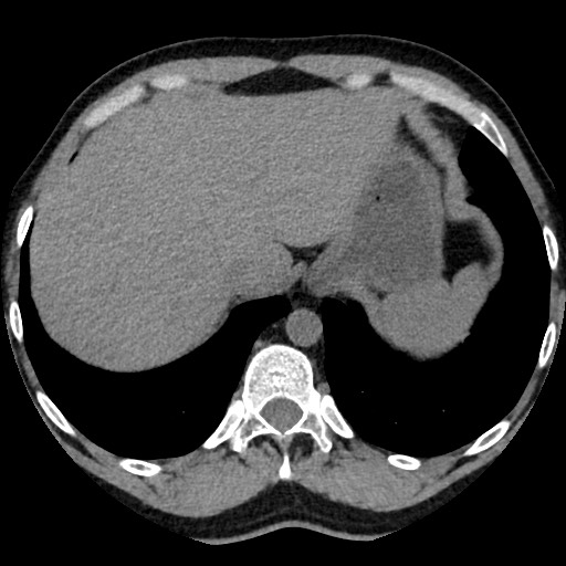Adrenal gland trauma (Radiopaedia 81351-95079 Axial non-contrast 17).jpg