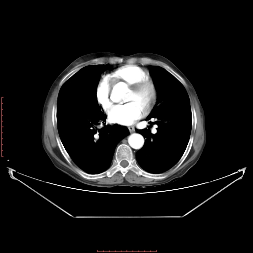 File:Adrenal hemangioma (Radiopaedia 68923-78668 Axial C+ arterial phase 4).jpg