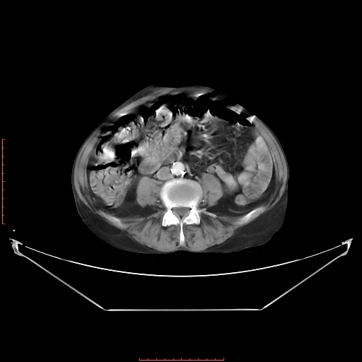 Adrenal hemangioma (Radiopaedia 68923-78668 Axial C+ portal venous phase 43).jpg