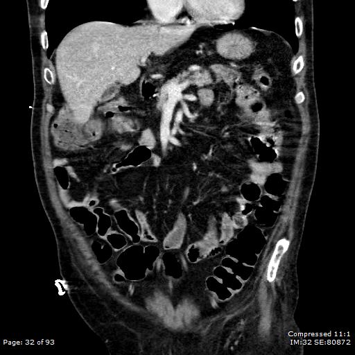 File:Adrenal metastasis (Radiopaedia 78425-91079 Sagittal C+ portal venous phase 19).jpg