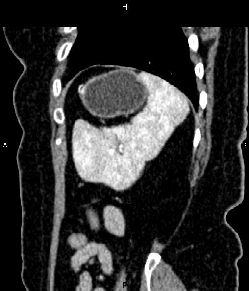 File:Adrenal myelolipoma (Radiopaedia 82742-96986 Sagittal renal cortical phase 88).jpg