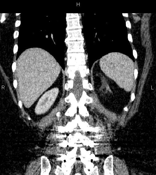 Adrenal myelolipoma (Radiopaedia 84319-99617 Coronal renal cortical phase 61).jpg