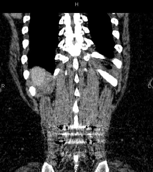 Adrenal myelolipoma (Radiopaedia 84319-99617 Coronal renal cortical phase 70).jpg