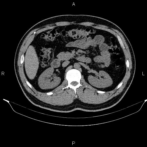 Adrenal myelolipoma (Radiopaedia 84321-99619 Axial non-contrast 45).jpg