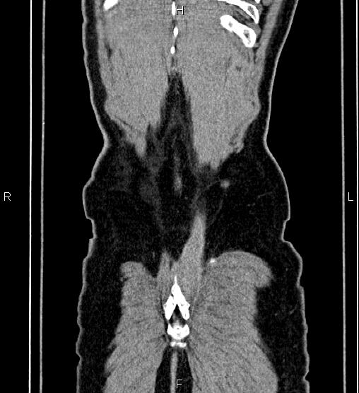 Adrenal myelolipoma (Radiopaedia 87794-104246 Coronal renal cortical phase 66).jpg