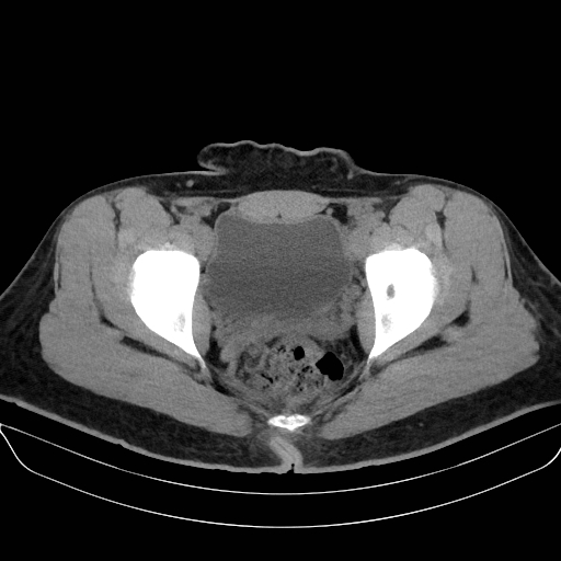 Adrenal myelolipoma - bilateral (Radiopaedia 74805-85810 Axial non-contrast 77).jpg