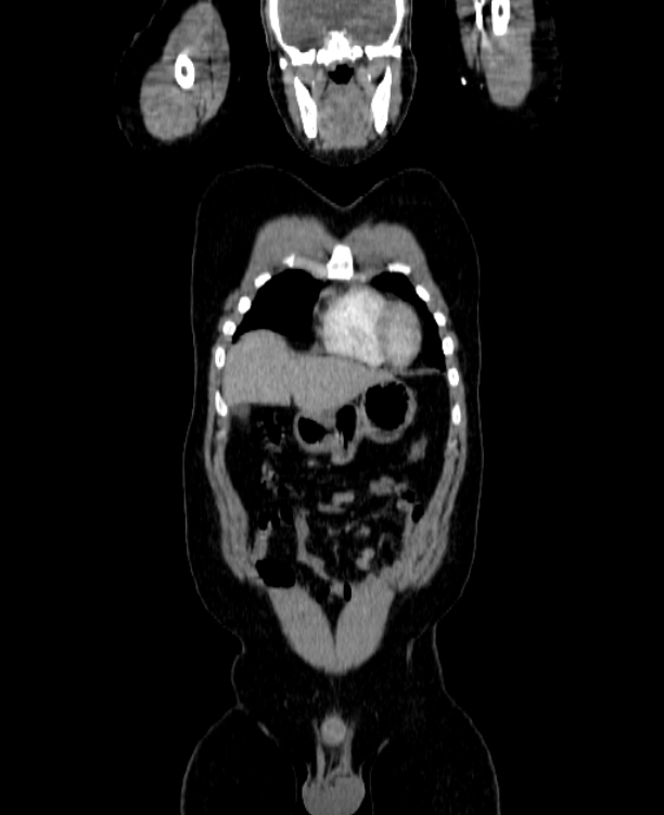 Adrenocortical carcinoma (Radiopaedia 80134-93438 Coronal C+ portal venous phase 38).jpg