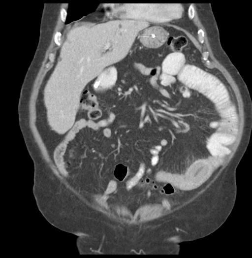 Adult ileal intussusception with secondary obstruction (Radiopaedia 30395-31051 Coronal C+ portal venous phase 20).jpg