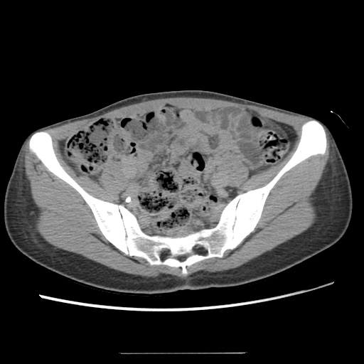 Adult polycystic kidney disease (Radiopaedia 48845-53876 Axial renal excretory phase 73).jpg