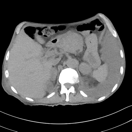 Advanced metastatic lung cancer (Radiopaedia 48910-53954 Axial non-contrast 60).png