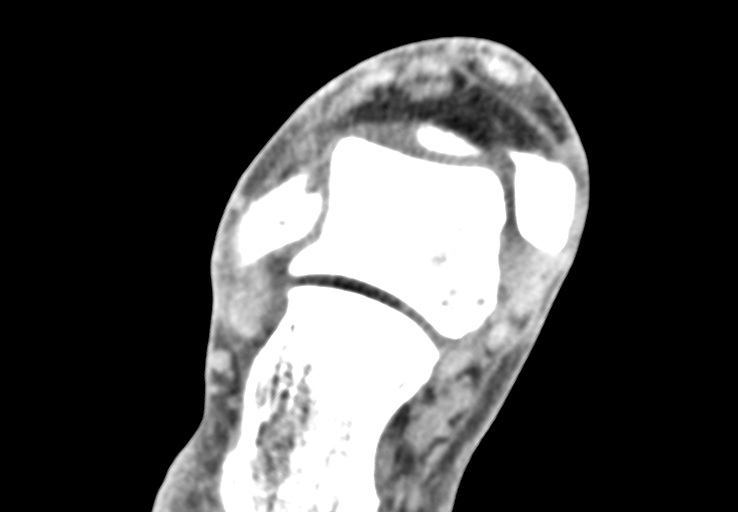 Advanced osteomyelitis due to open metatarsal fracture (Radiopaedia 83891-99095 Axial non-contrast 6).jpg