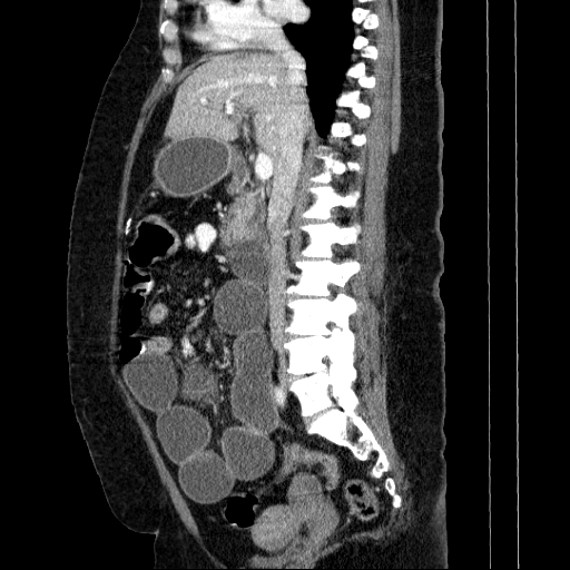File:Afferent loop syndrome - secondary to incarcerated trocar site hernia (Radiopaedia 82959-97305 Sagittal C+ portal venous phase 87).jpg