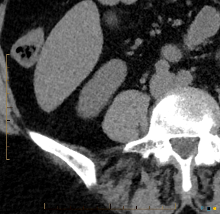 Aggressive angiomyolipoma (Radiopaedia 55765-62328 Axial non-contrast 49).jpg