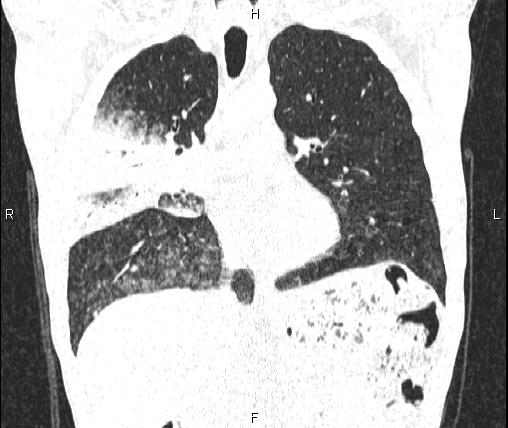 File:Air bronchogram in pneumonia (Radiopaedia 85719-101512 Coronal lung window 27).jpg