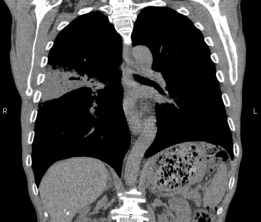 Air bronchogram in pneumonia (Radiopaedia 85719-101512 Coronal non-contrast 35).jpg