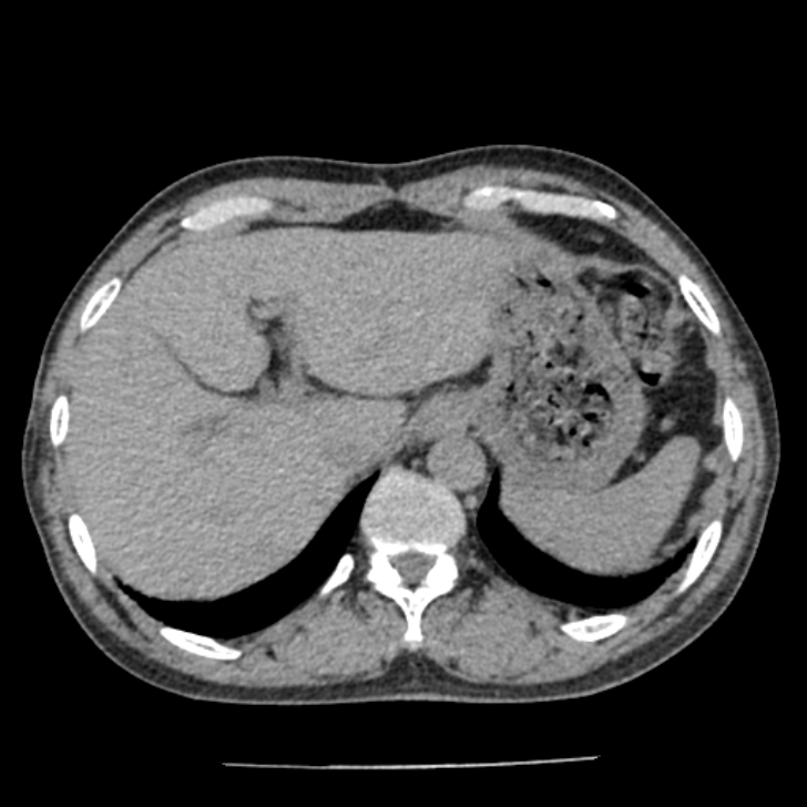 Airway foreign body in adult (Radiopaedia 85907-101779 Axial liver window 190).jpg