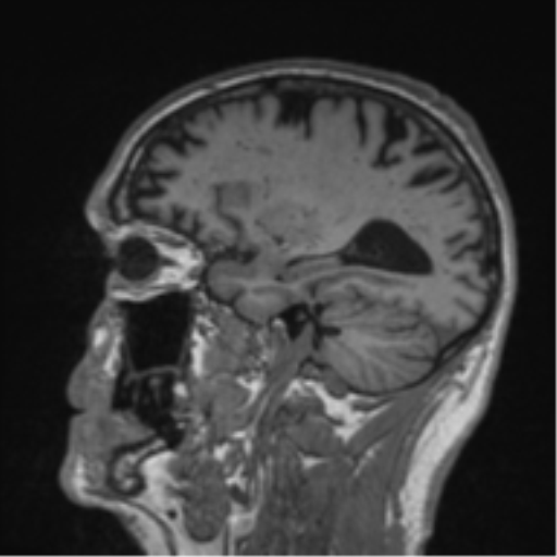 Alzheimer's disease- with Gerstmann syndrome and dressing apraxia (Radiopaedia 54882-61150 Sagittal T1 20).png