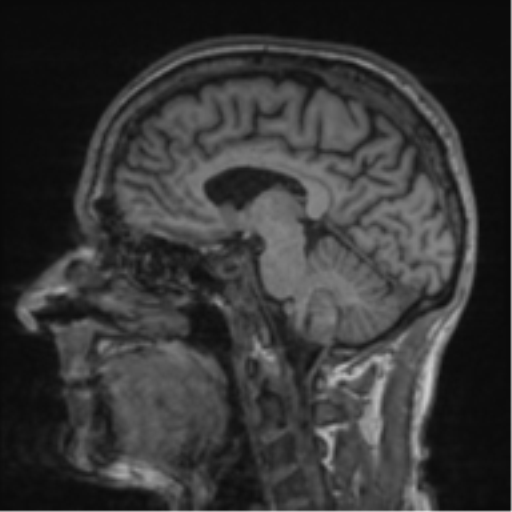 File:Alzheimer's disease- with apraxia (Radiopaedia 54763-61011 Sagittal T1 32).png