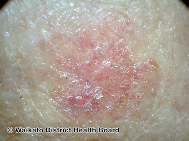 File:Amelanotic melanoma (DermNet NZ amelanotic-melanoma-035).jpg