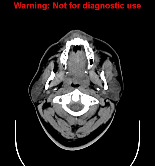 File:Ameloblastoma (Radiopaedia 33126-34164 A 1).jpg